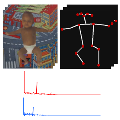 CP-AGCN: Pytorch-Based Attention Informed Graph Convolutional Network for Identifying Infants at Risk of Cerebral Palsy