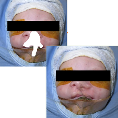 INCLG: Inpainting for Non-Cleft Lip Generation with a Multi-Task Image Processing Network